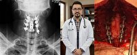 نجات بیمار از خطر فلج شدن در سنندج