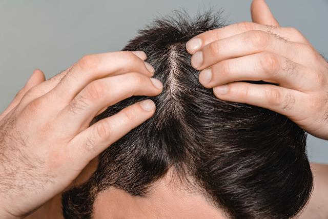 چرا موهای من همیشه چرب است؟